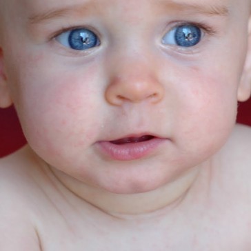 Altıncı Hastalık Roseola