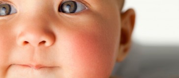 Bebek ve Çocuklarda Göz Çapaklanması